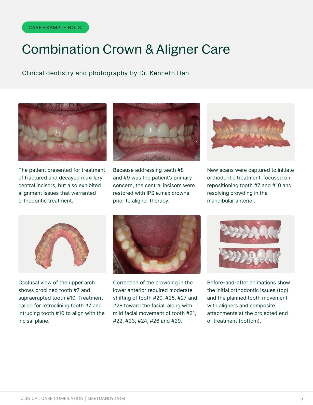 Precise, Predictable Outcomes: A Clear Aligner Case Compilation