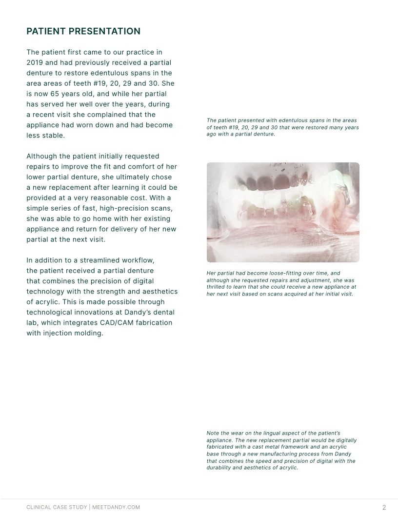 2-Appointment Cast Metal Partial Dentures