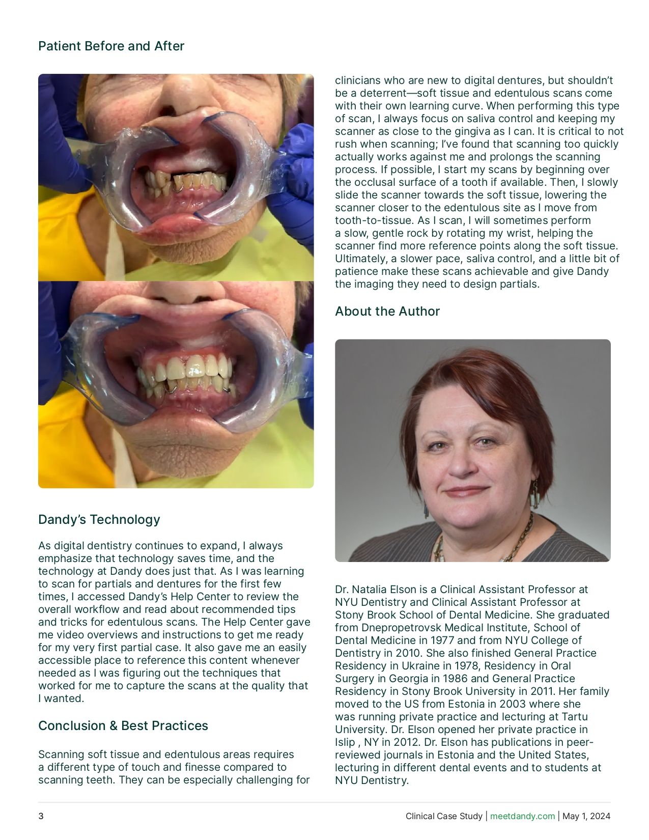 Restoring the anterior zone with maxillary partials