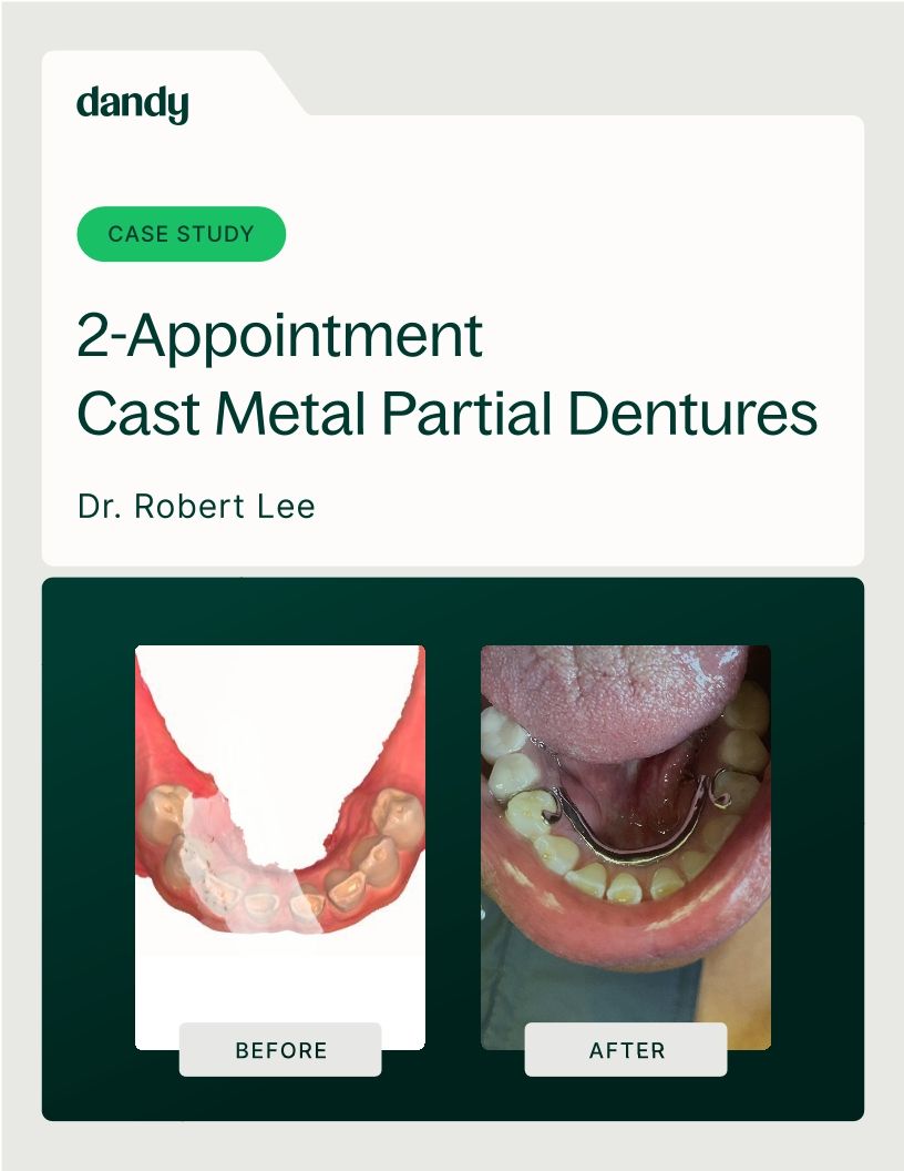 2-Appointment Cast Metal Partial Dentures