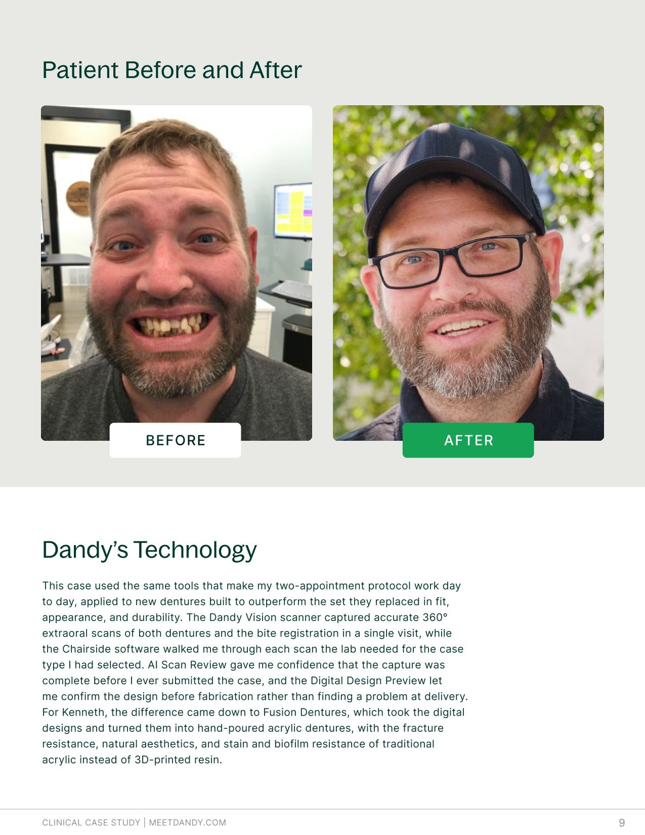 Case Study: Fusion Dentures Bring Traditional Acrylic to a Digital Workflow