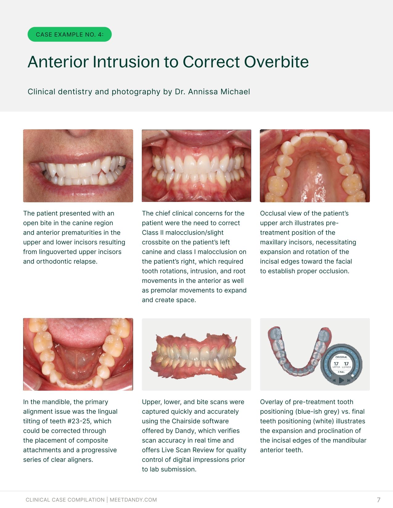 Precise, Predictable Outcomes: A Clear Aligner Case Compilation