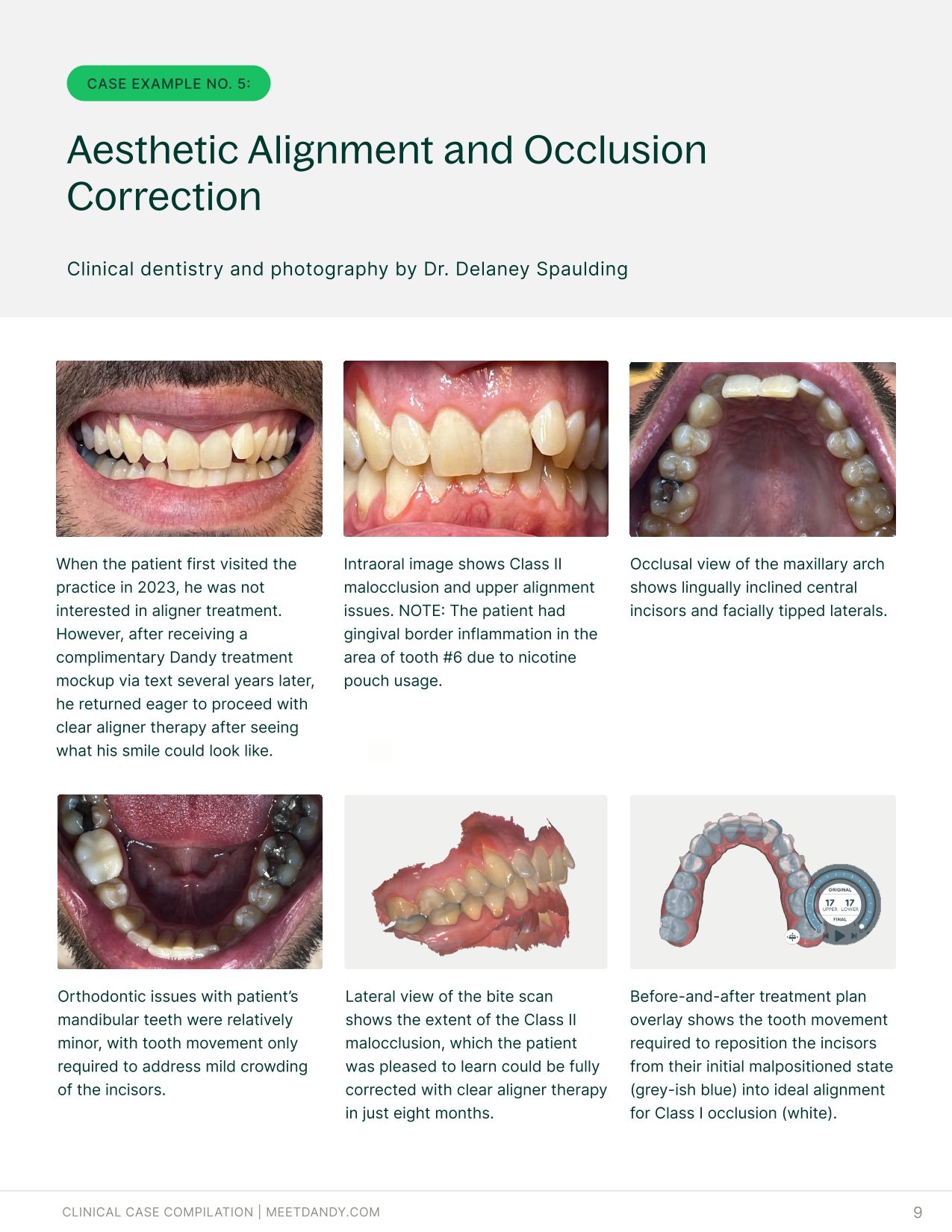 Precise, Predictable Outcomes: A Clear Aligner Case Compilation