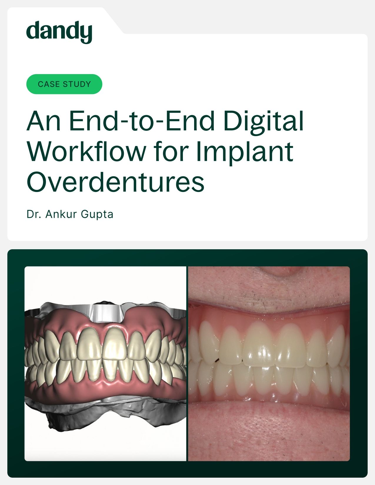 An End-to-End Digital Workflow for Implant Overdentures