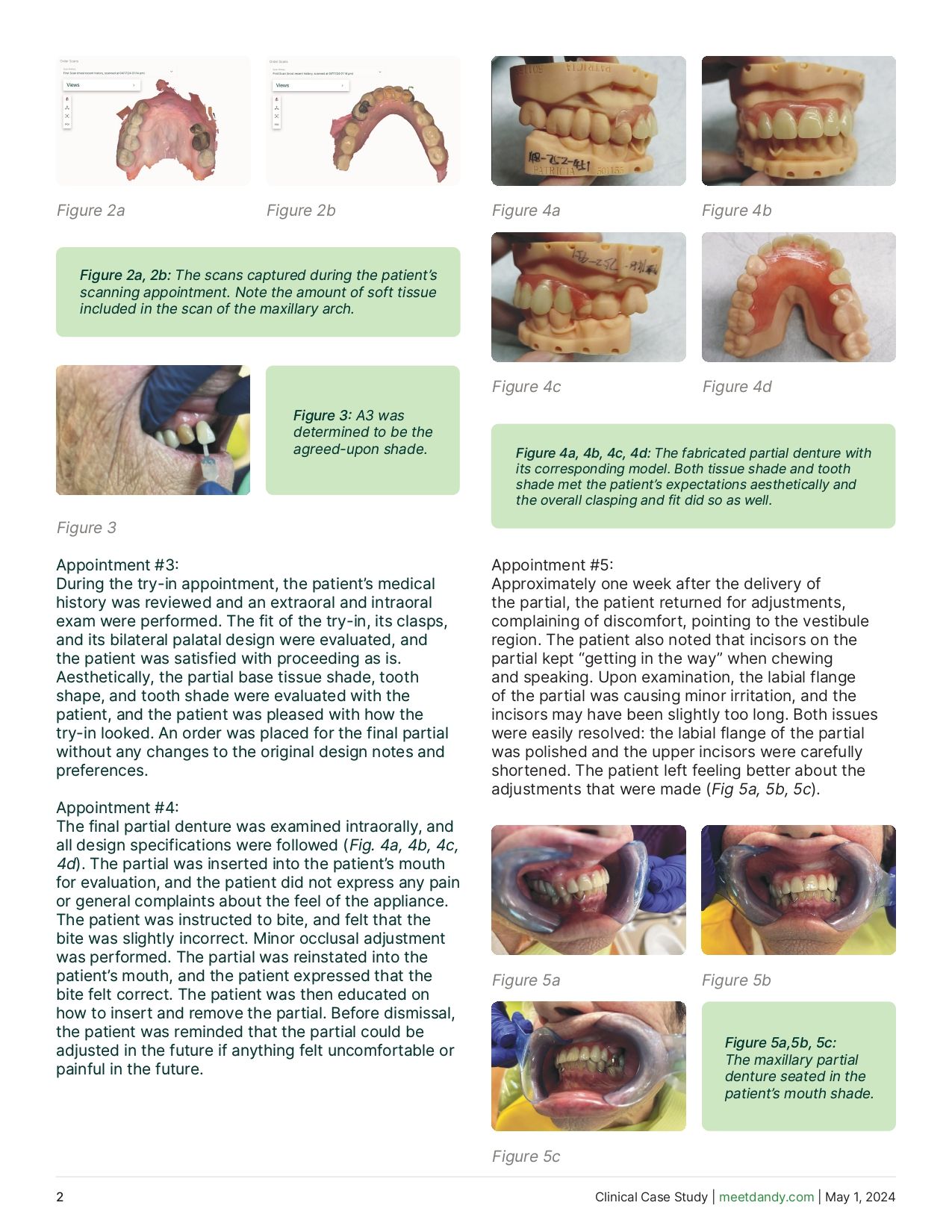 Restoring the anterior zone with maxillary partials