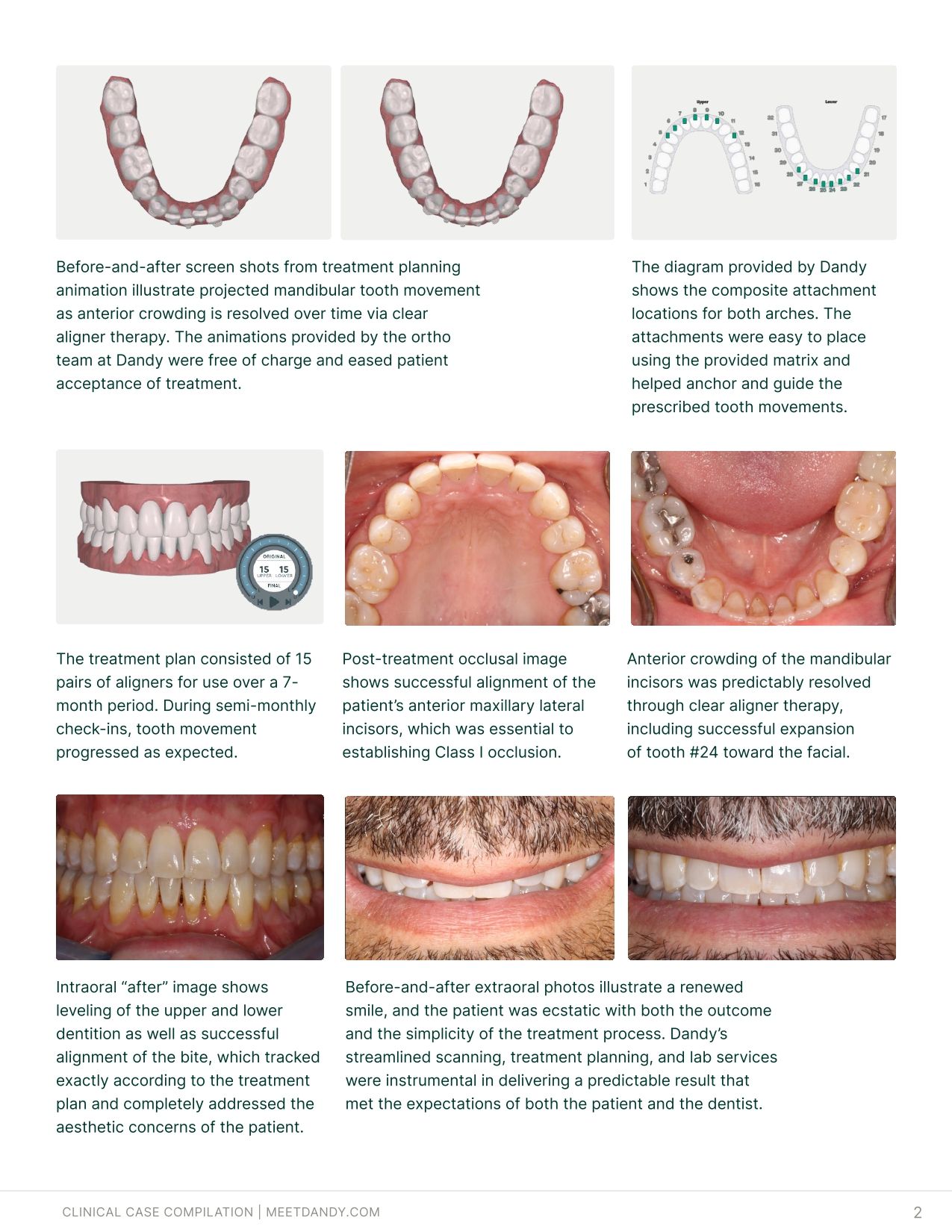 Precise, Predictable Outcomes: A Clear Aligner Case Compilation