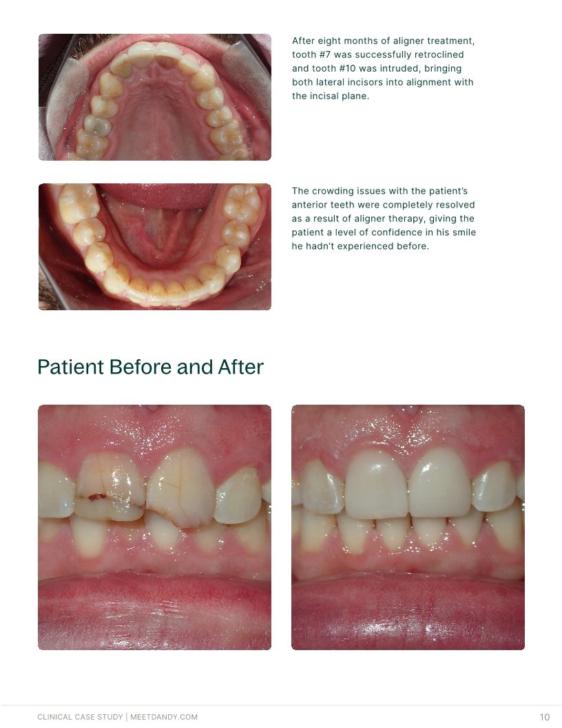 Precision-Driven Crown and Aligner Care
