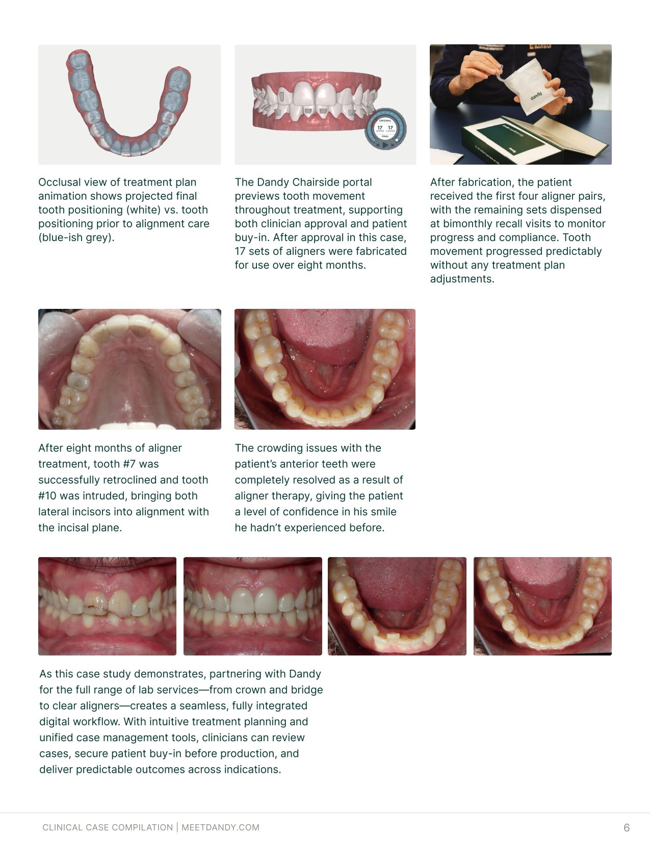 Precise, Predictable Outcomes: A Clear Aligner Case Compilation