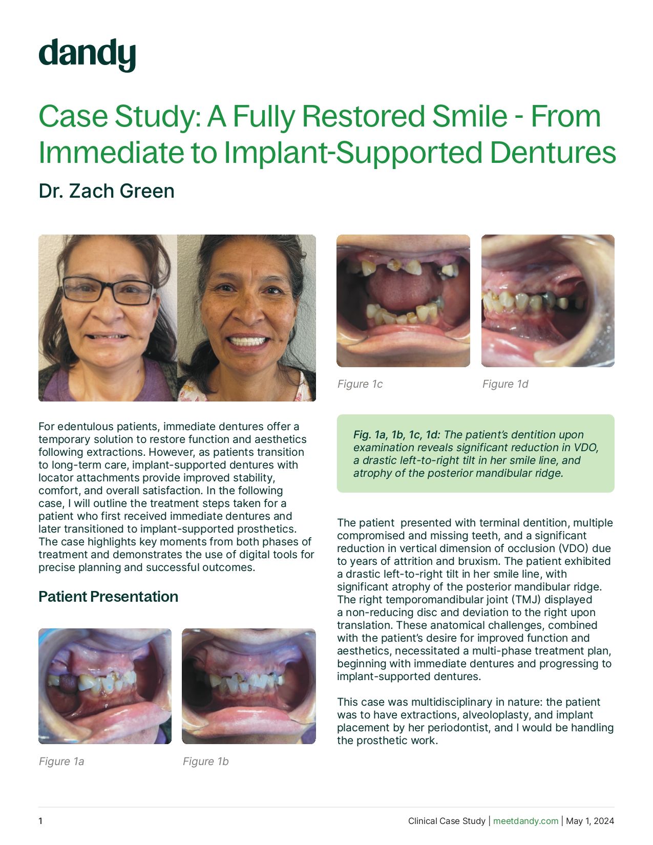 A Fully Restored Smile - From Immediate to Implant-Supported Dentures