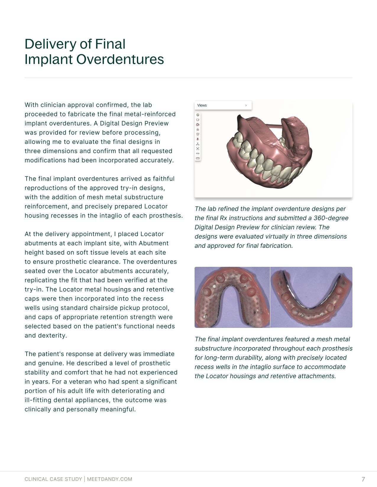 An End-to-End Digital Workflow for Implant Overdentures
