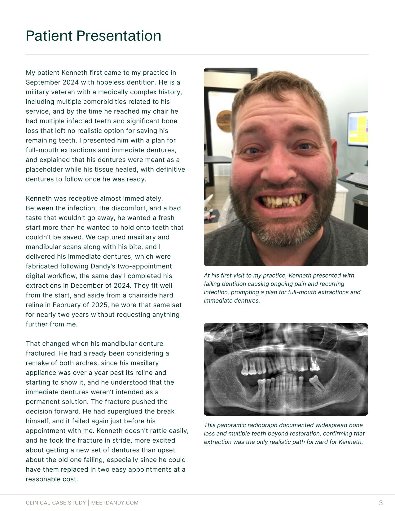 Case Study: Fusion Dentures Bring Traditional Acrylic to a Digital Workflow