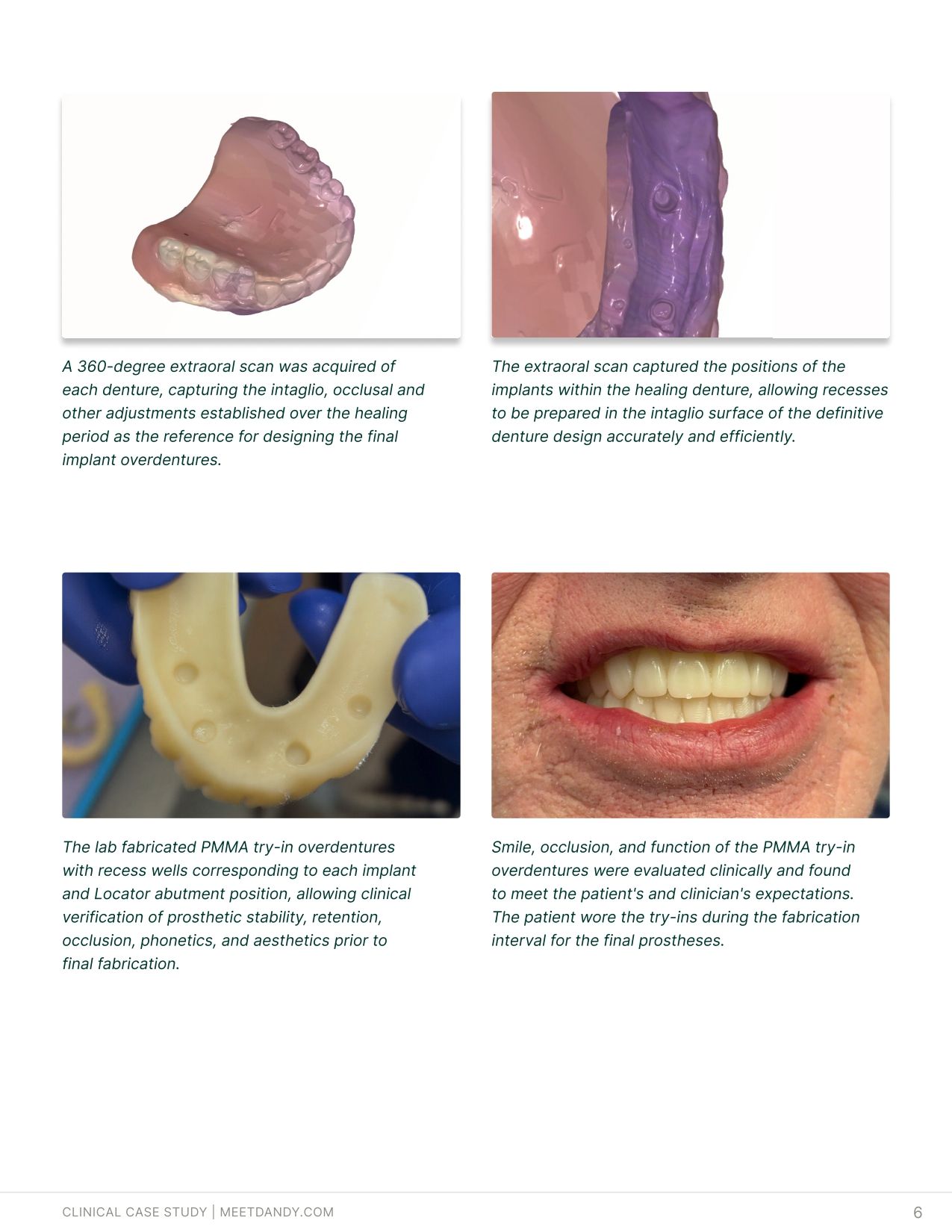 An End-to-End Digital Workflow for Implant Overdentures