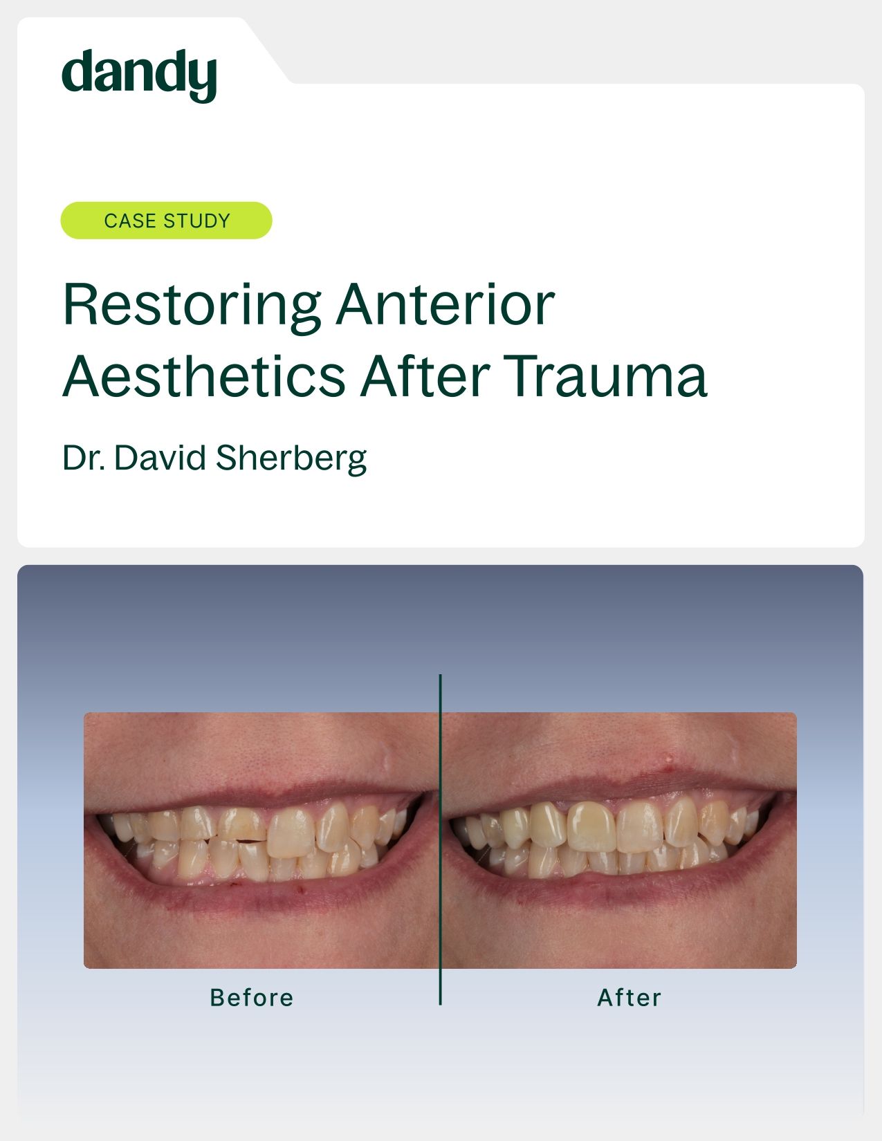 Restoring Anterior Aesthetics After Trauma
