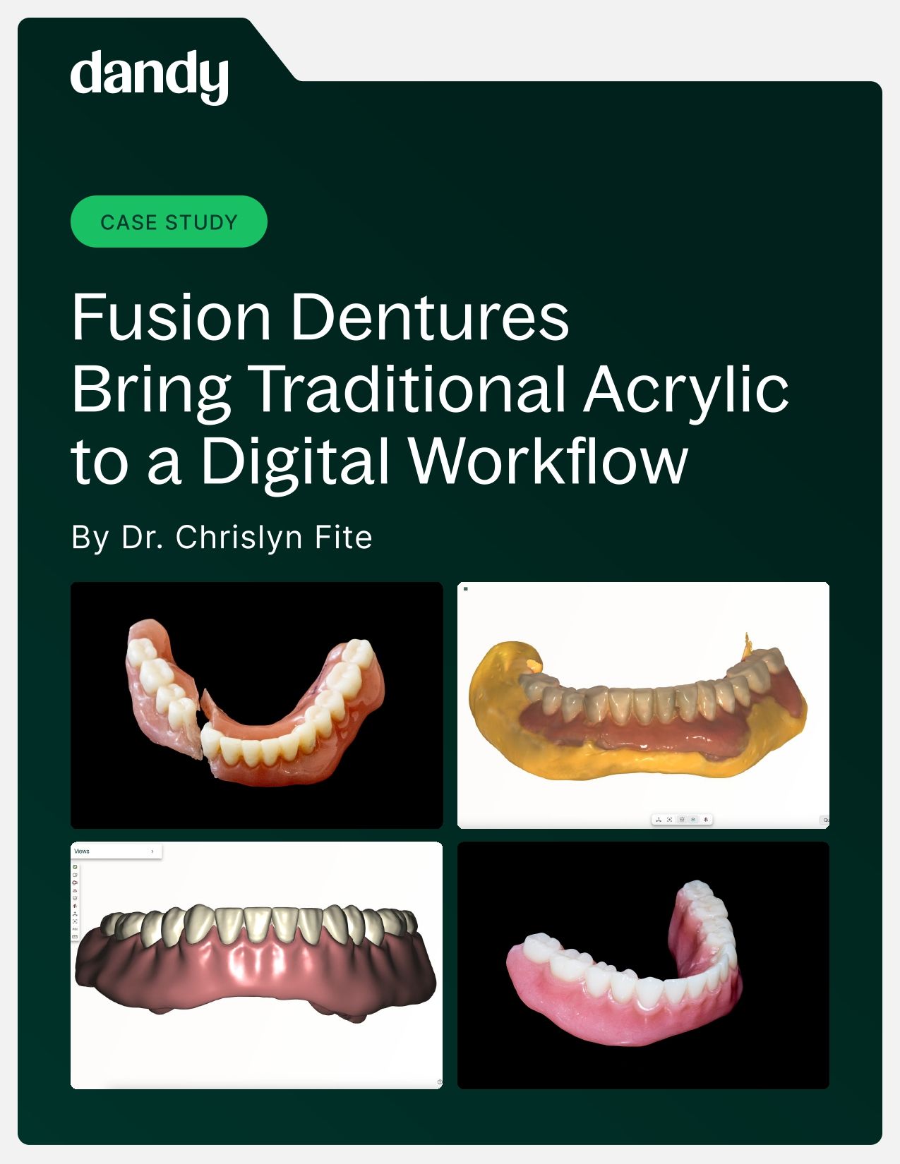 Case Study: Fusion Dentures Bring Traditional Acrylic to a Digital Workflow