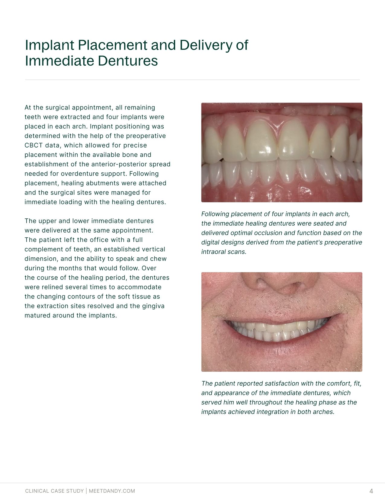 An End-to-End Digital Workflow for Implant Overdentures