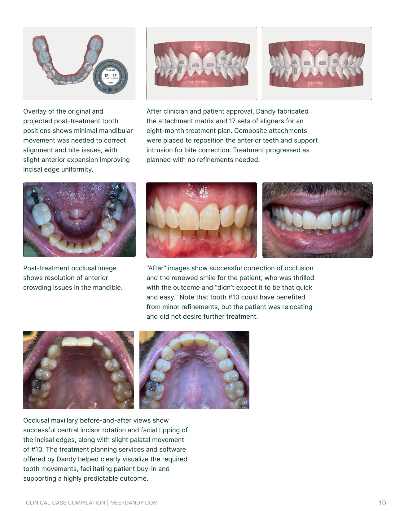 Precise, Predictable Outcomes: A Clear Aligner Case Compilation