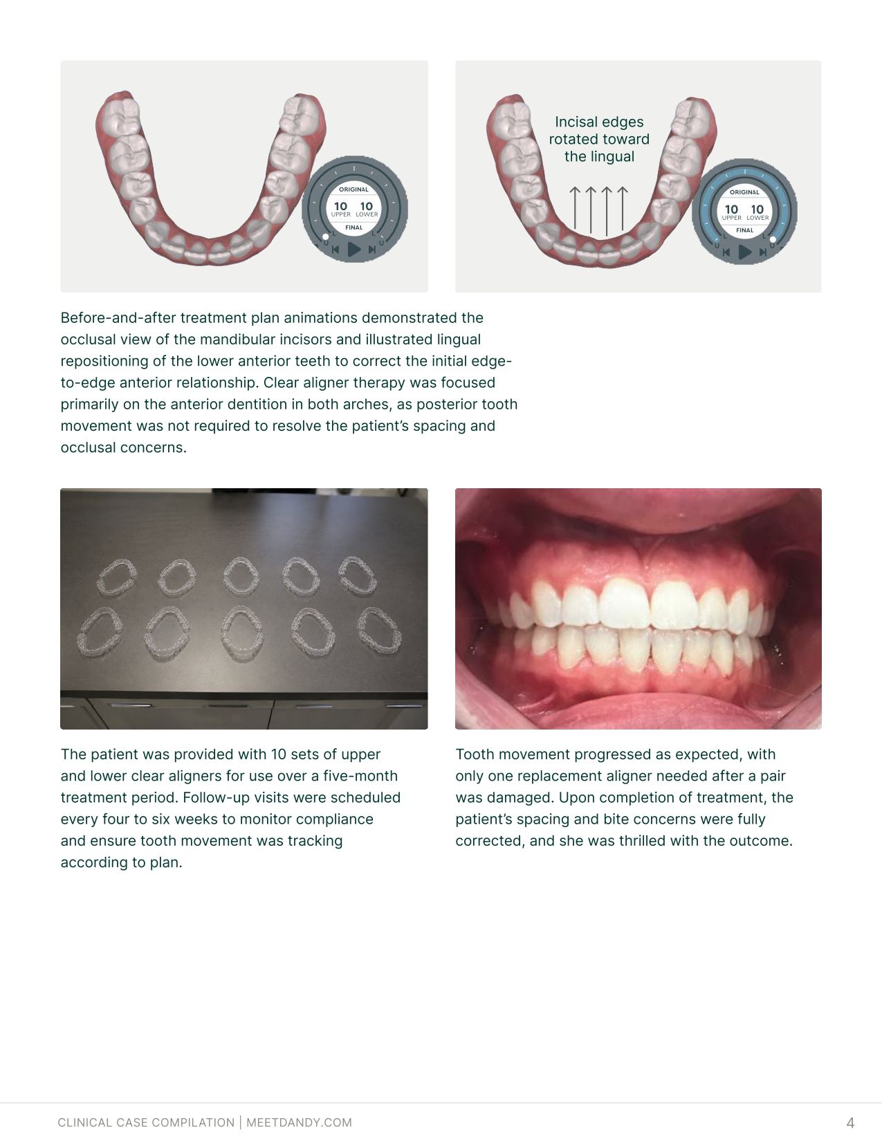 Precise, Predictable Outcomes: A Clear Aligner Case Compilation