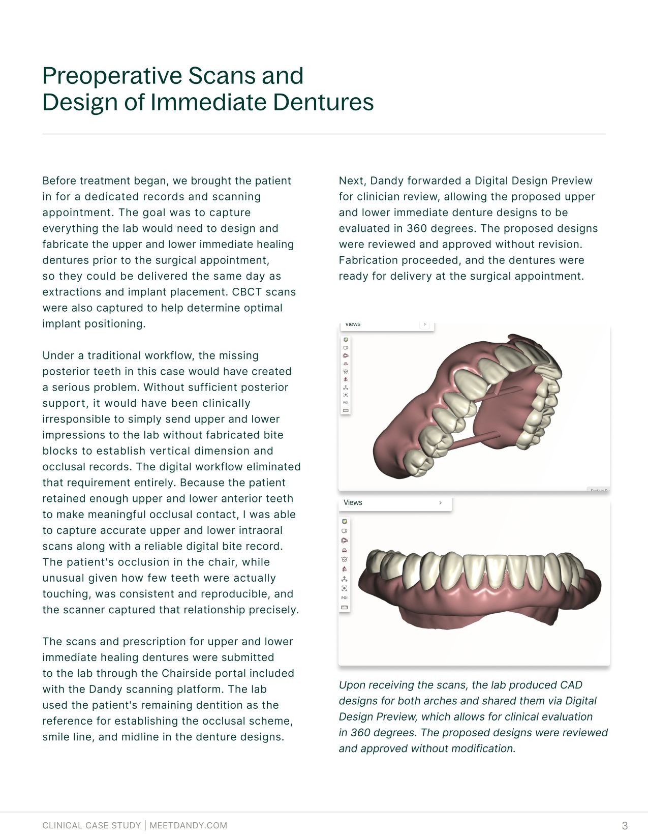 An End-to-End Digital Workflow for Implant Overdentures