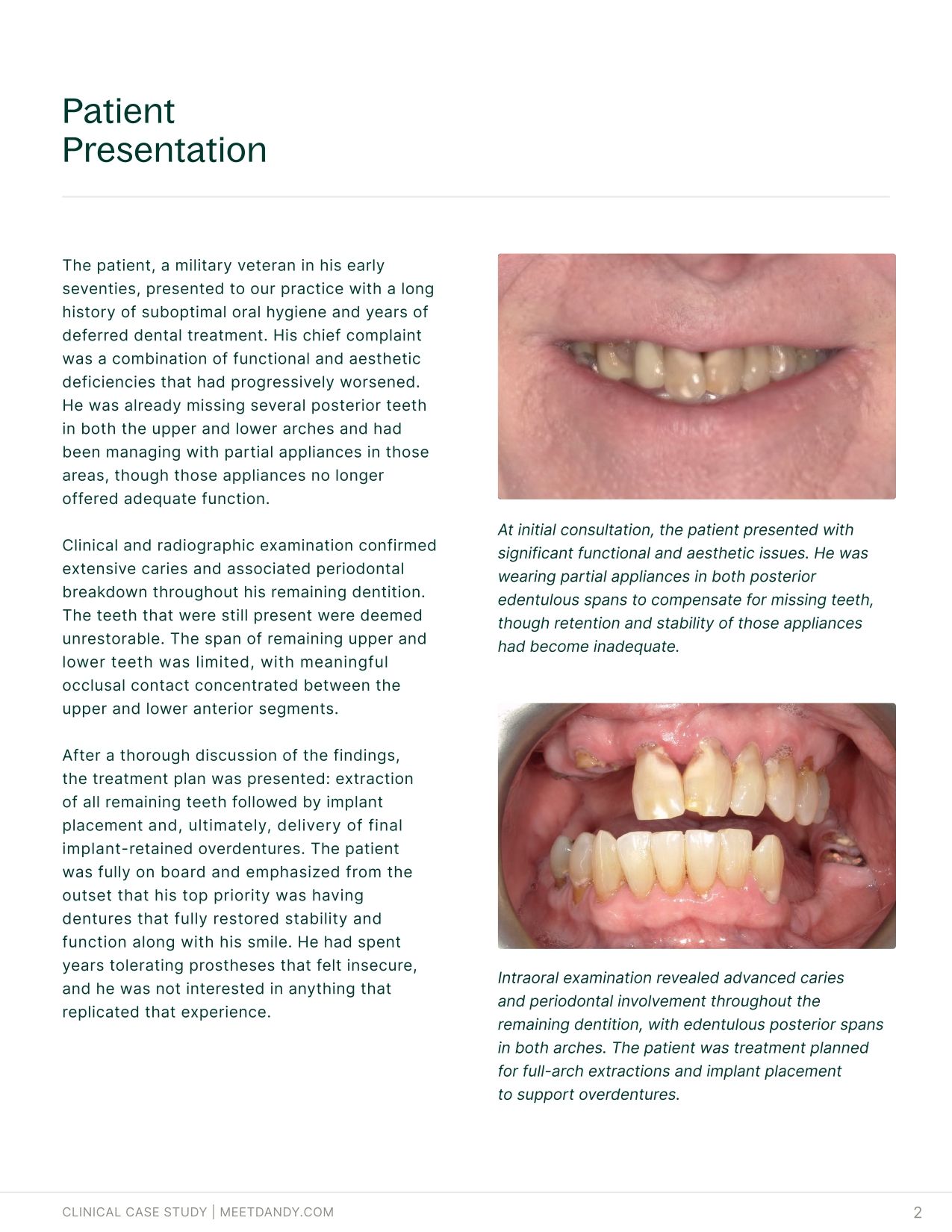 An End-to-End Digital Workflow for Implant Overdentures