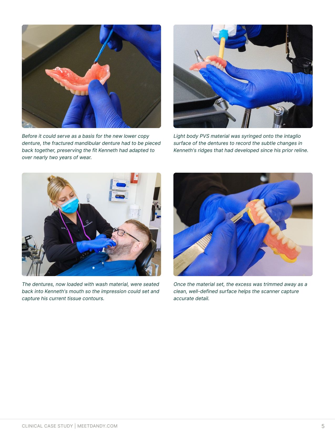 Case Study: Fusion Dentures Bring Traditional Acrylic to a Digital Workflow