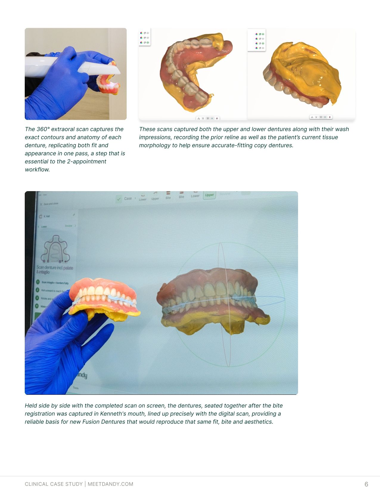 Case Study: Fusion Dentures Bring Traditional Acrylic to a Digital Workflow