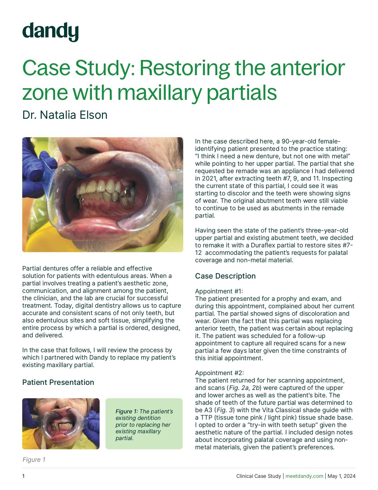 Restoring the anterior zone with maxillary partials