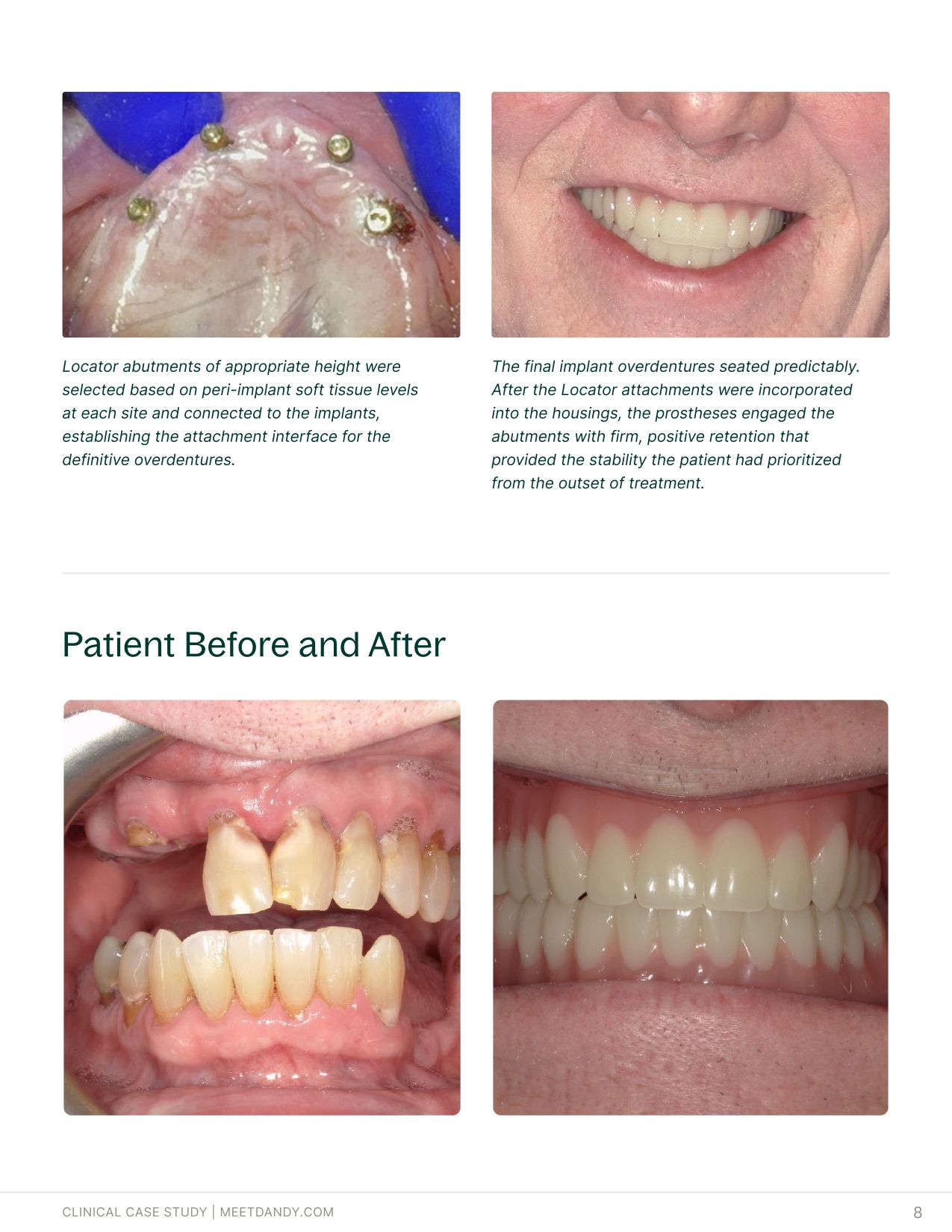 An End-to-End Digital Workflow for Implant Overdentures