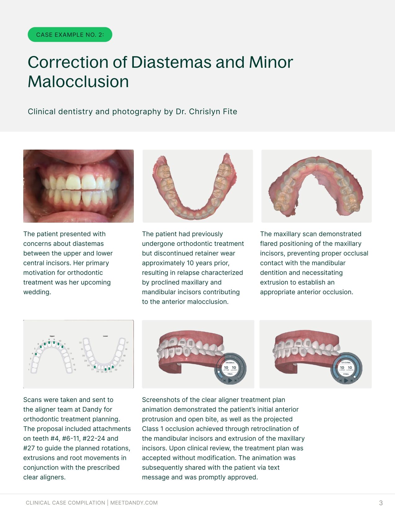 Precise, Predictable Outcomes: A Clear Aligner Case Compilation