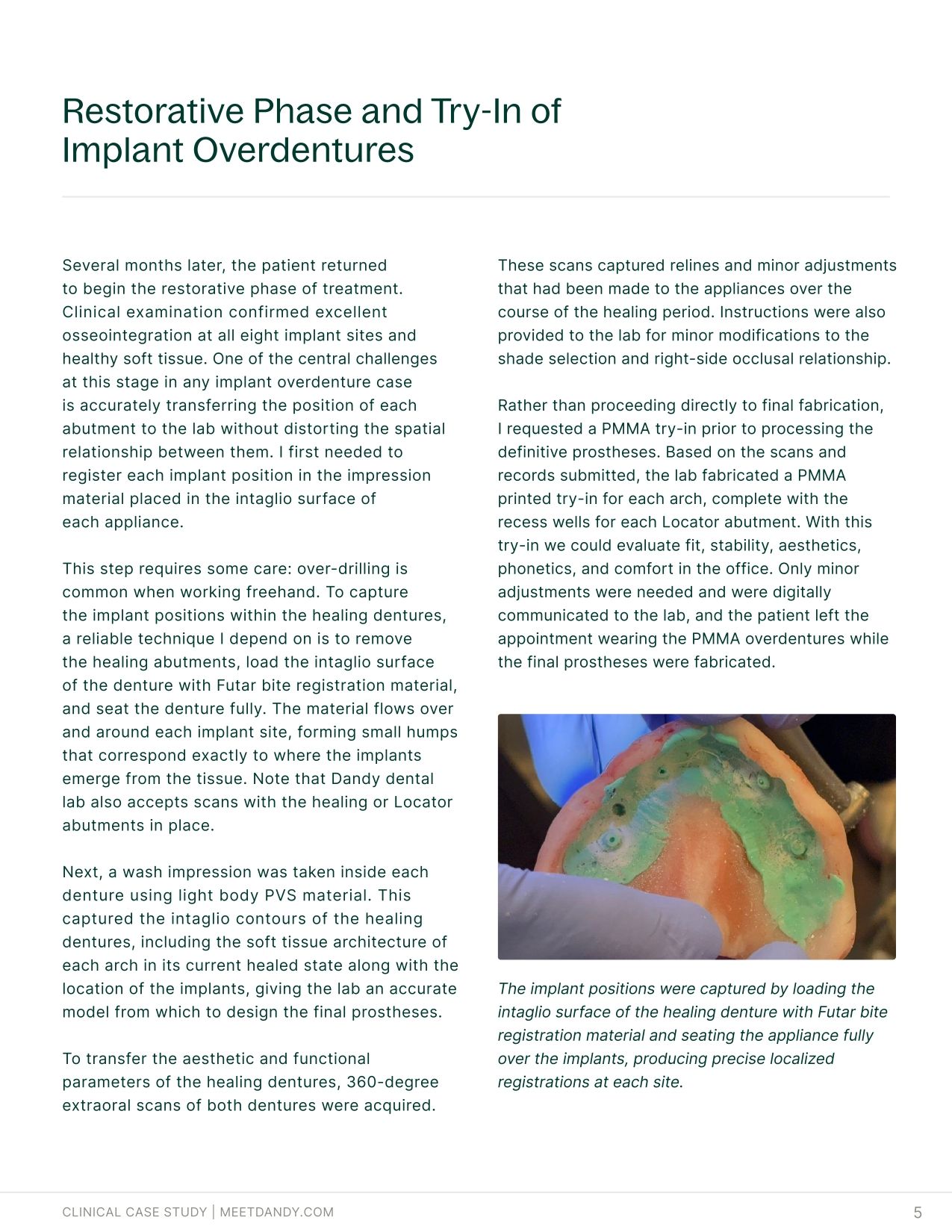 An End-to-End Digital Workflow for Implant Overdentures