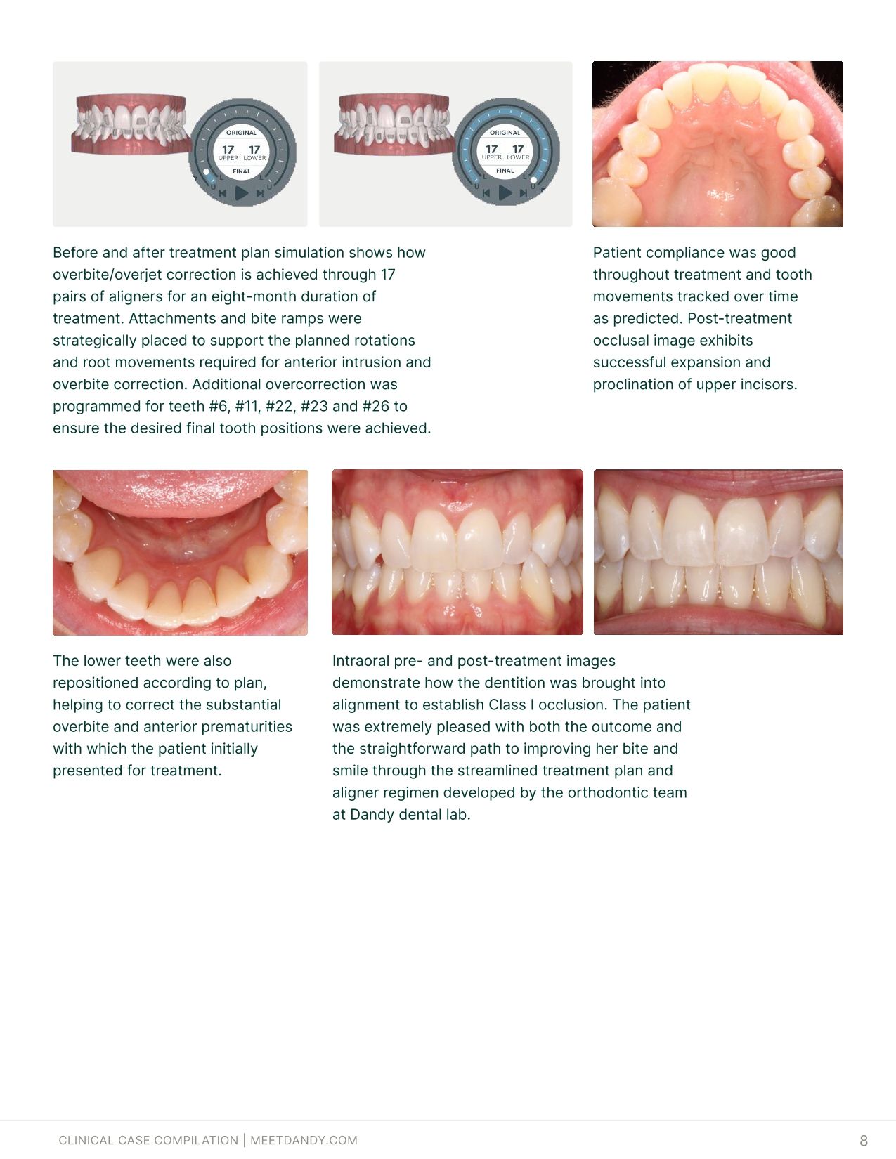 Precise, Predictable Outcomes: A Clear Aligner Case Compilation