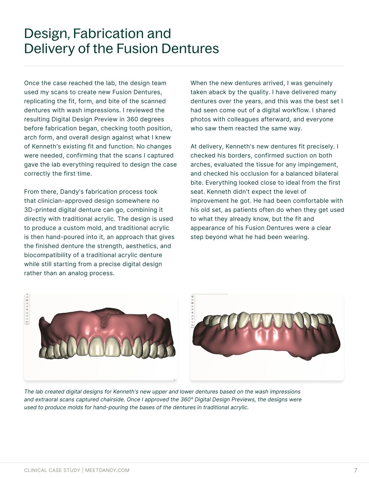 Case Study: Fusion Dentures Bring Traditional Acrylic to a Digital Workflow