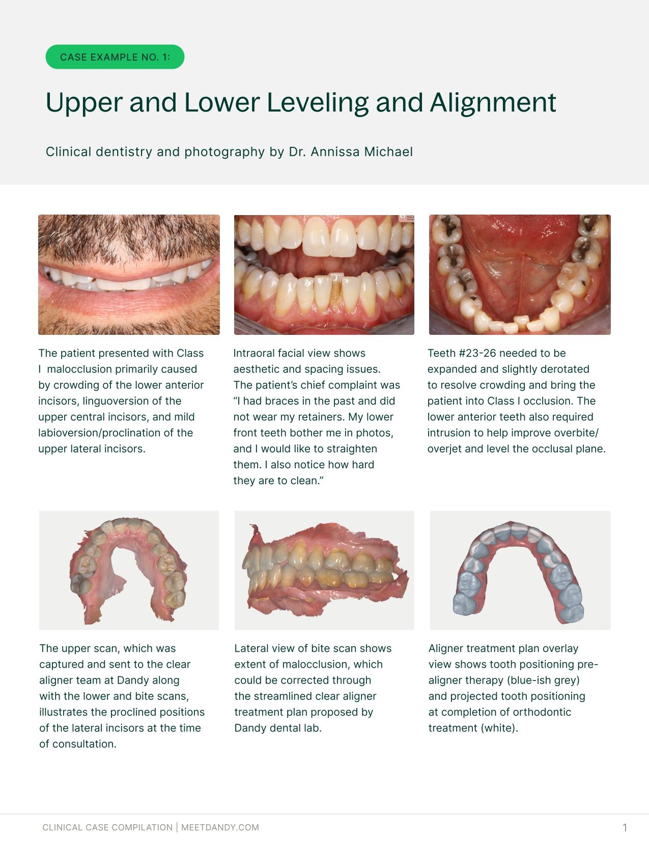 Precise, Predictable Outcomes: A Clear Aligner Case Compilation